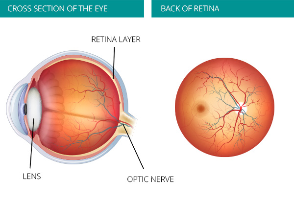 Glaucoma cross section of Eye, Ryans Opticians Wexford